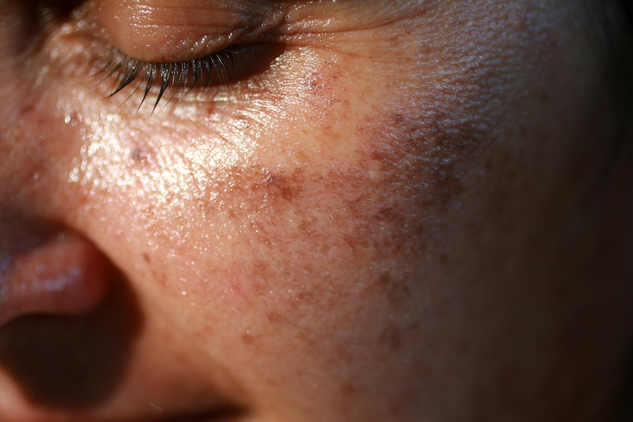 When Hyperpigmentation Impacts Confidence : a reason to innovate